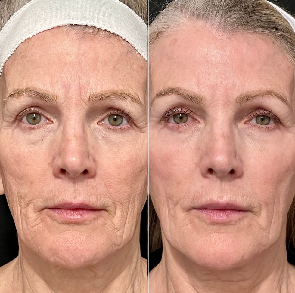 Before and after comparison of a client following Botox Cosmetic treatment