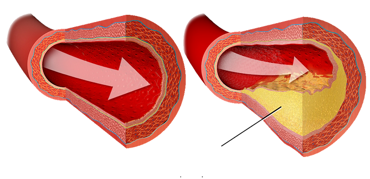 Garcinia Cambogia Helps Clogged Arteries