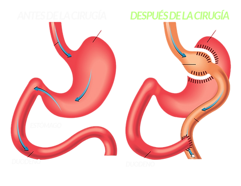 Bypass Gástrico en Y de Roux en Los Cabos