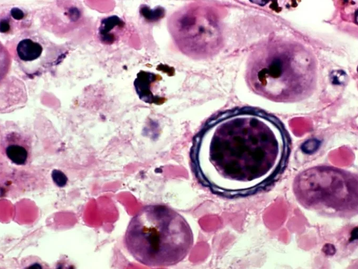 Após lavagem nasal, homem morre por ‘ameba comedora de cérebro’