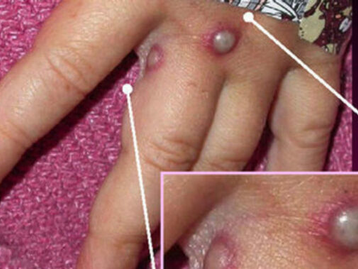 Enfermeira explica como acontece a transmissão do vírus da varíola dos macacos