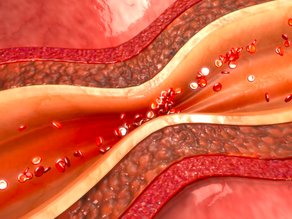 Espasmo de las arterias coronarias