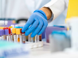 Desarrollan un test para detectar el cáncer de páncreas mediante una muestra de sangre