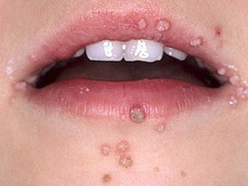 Infección bucal por el virus del papiloma humano