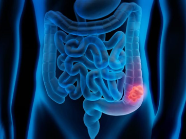 El 10 % de los diagnósticos de cáncer de colon se hacen antes del paciente cumplir 50 años
