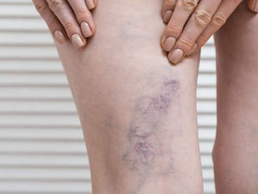 Elimina las varices sin bisturí: así funcionan los nuevos tratamientos