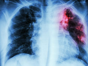 Tuberculosis pulmonar