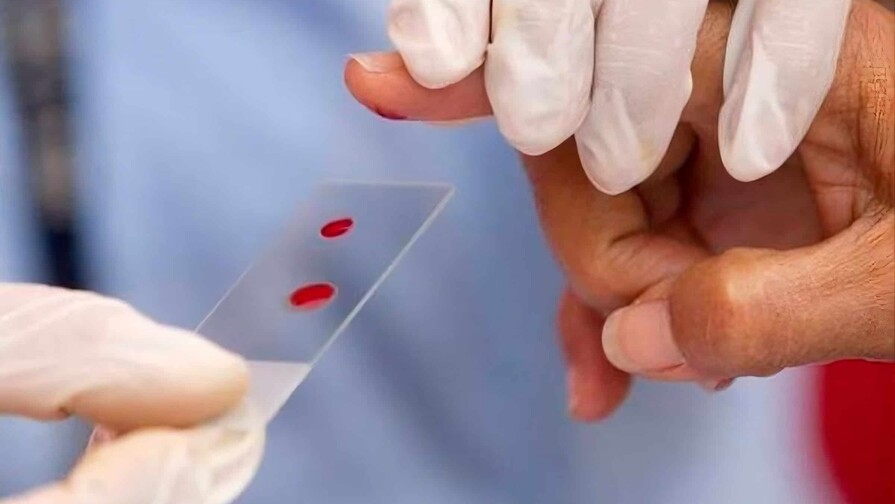 El 82 % de los casos en República Dominicana corresponde a hemofilia A, según los datos. (FUENTE EXTERNA)