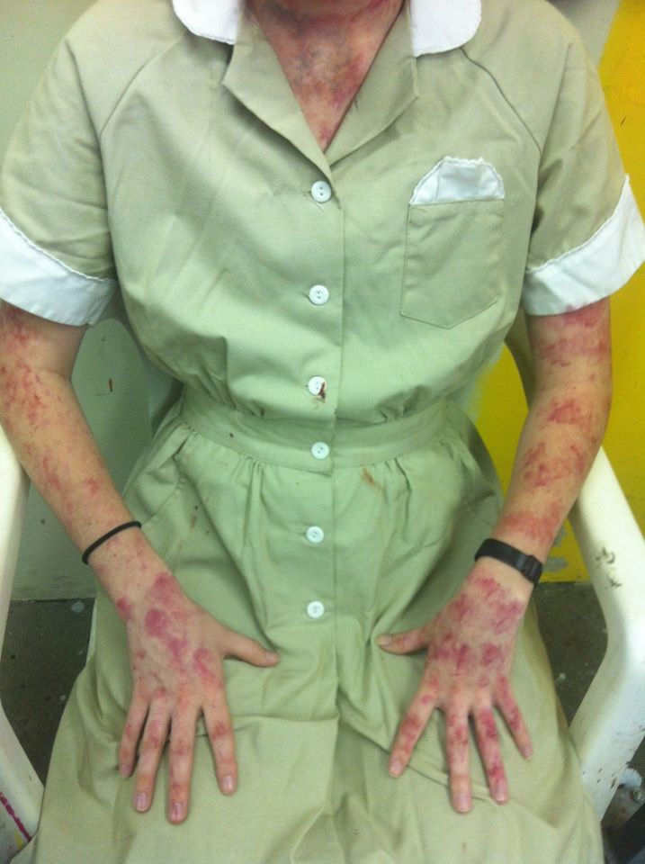 Viral Infection Rash