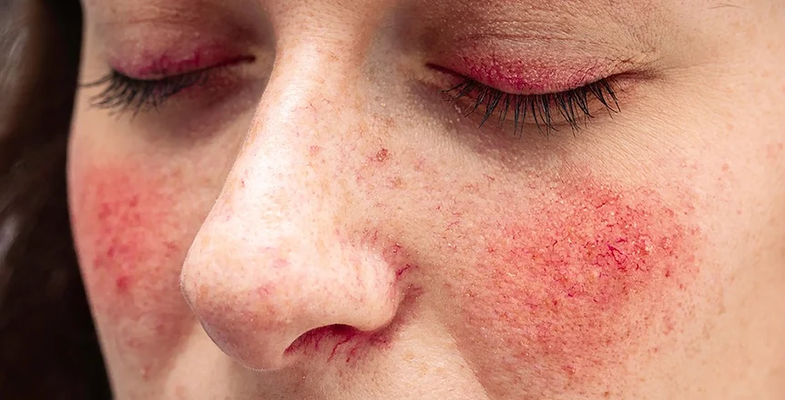 ocular rosacea.webp