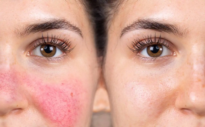 ocular rosacea 2.webp