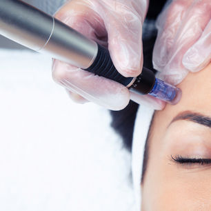 Transform Your Skincare Routine with Microneedling Treatment.