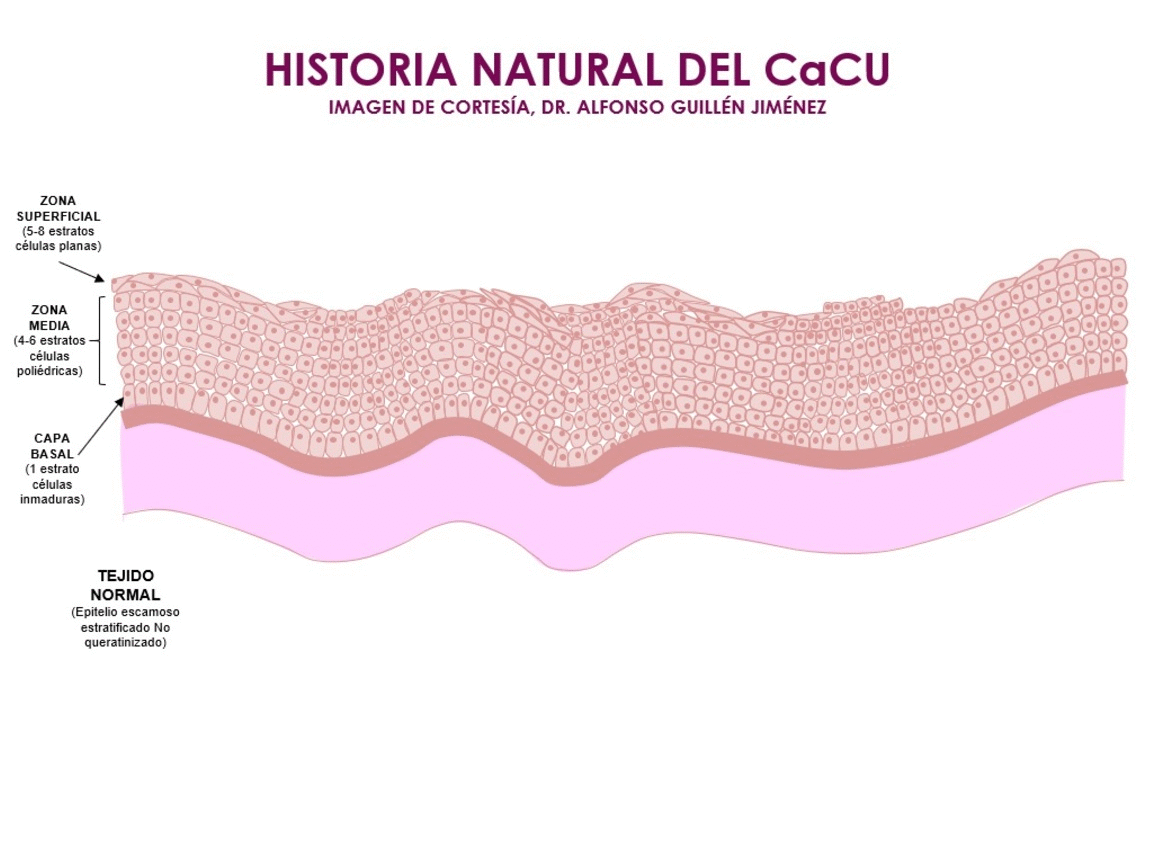 CANCER CERVICOUTERINO.gif