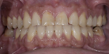 Dental orthodontics and veneers