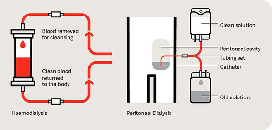 What is dialysis?
