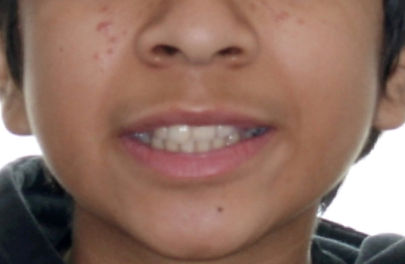 invisalign-before-smiling-woodbine-nashv
