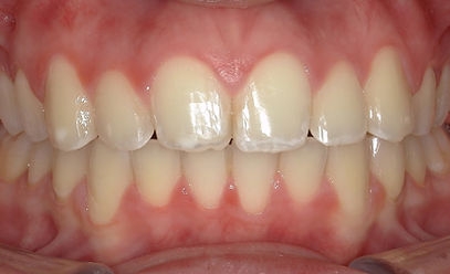 clear-braces-after-intraoral-crieve-hall