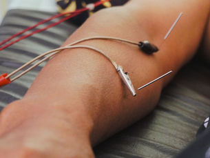 Close-up of dry needling with electrical stimulation showing thin needles inserted into a patient's leg and connected to electrical stimulation clips and wires.