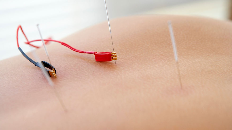 Close-up of dry needles inserted into a person’s skin, with red and black electrical clips attached to two needles for Dry Needling With Electrical Stimulation.