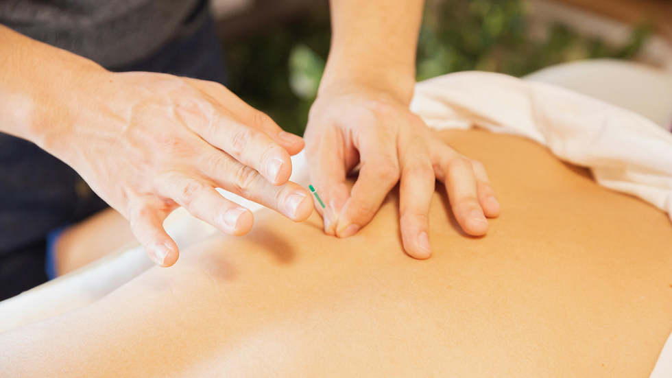 Dry needling treatment being performed on the lower back by a healthcare professional.