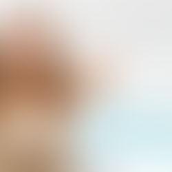 Anti Wrinkle Injections How Soon is Too Soon to Start ?