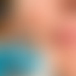 Tips to avoid bruising when having cosmetic injections