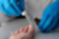 Fungal Nail Infection Treatment
