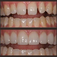 zirkonyum kaplama ve gülüş tasarımı yapılmış hastanın ağız içi öncesi ve sonrası 