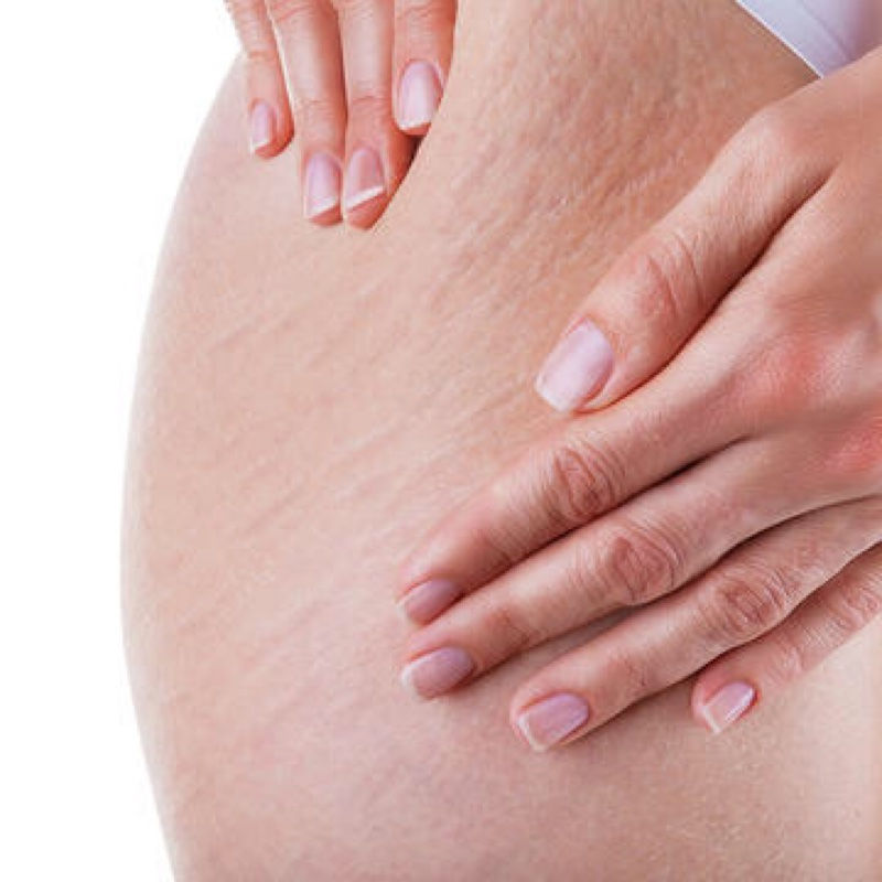 Stretch Marks Problem