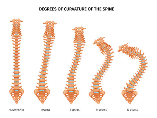 Understanding the Types of Spondylolisthesis: A Comprehensive Guide