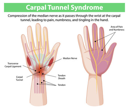 Understanding Carpal Tunnel Syndrome: Causes, Symptoms, and Treatment