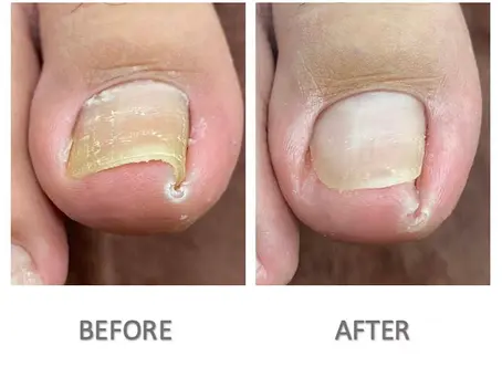 Ingrown Toenails: Why Do They Happen?