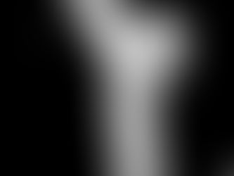 OSTEOPENIA