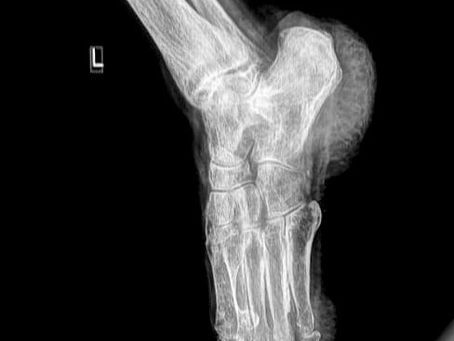 OSTEOPENIA