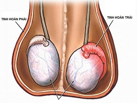 Đau tinh hoàn nhưng không sưng liệu có nguy hiểm