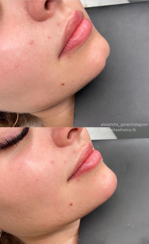 Korekta Brody w Lublinie,  Dr  Aleksandra Goraj, medycyna Estetyczna, najlepszy lekarz