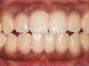 当院のホワイトニング治療紹介