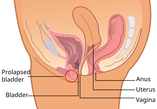 a diagram of a prolapsed bladder