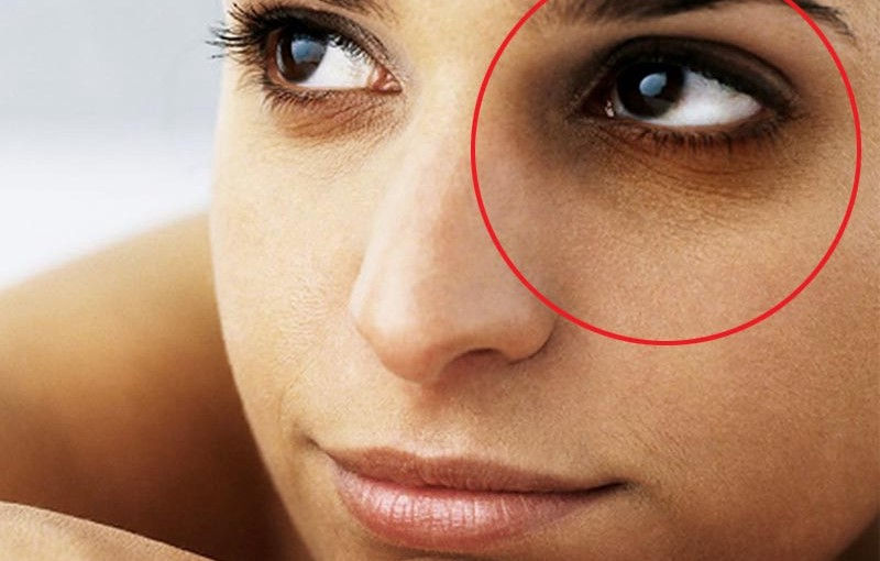 Natural Home Remedies to Remove Dark Circles