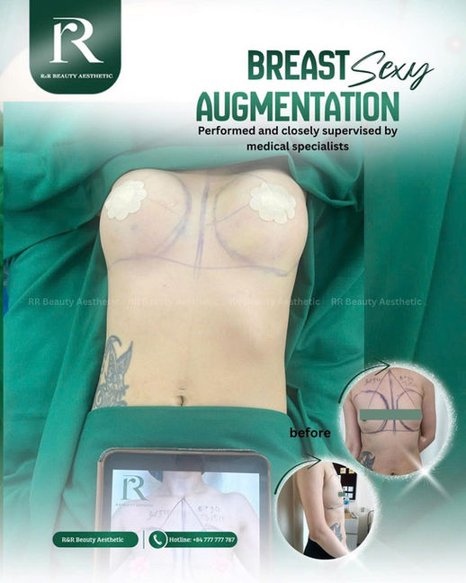 Before and after breast augmentation for very small breasts using 315 cc Motiva Ergonomix implants by R&R Beauty Aesthetic in Vietnam.