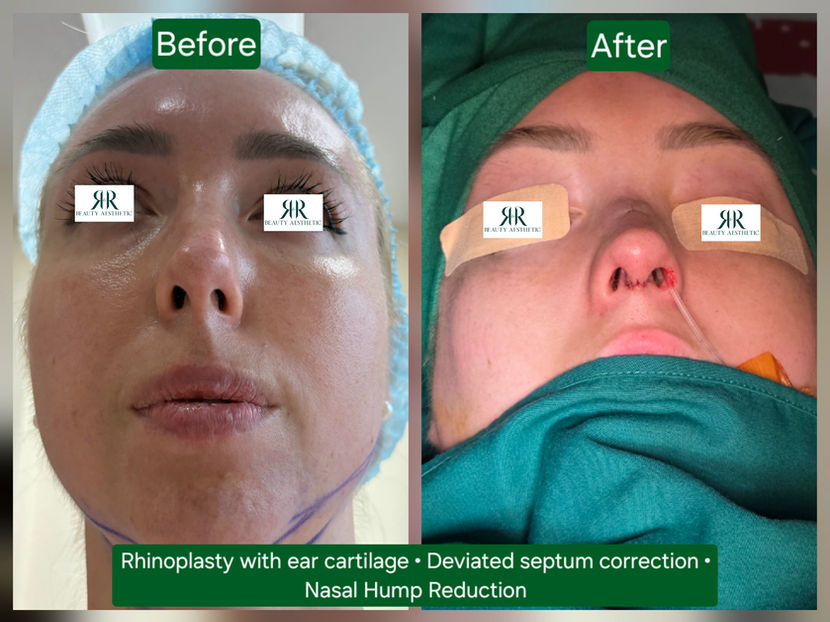 Before and after rhinoplasty with ear cartilage, deviated septum correction and nasal hump reduction for an australian client
