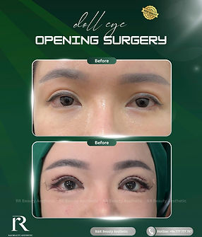 Before and After Results for Blepharoplasty in R&R Beauty Clinic in Ho Chi Minh City, Vietnam