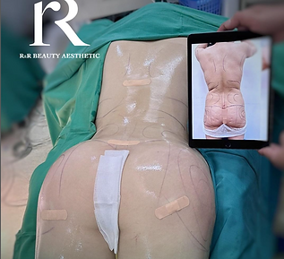 Liposuction 1.png