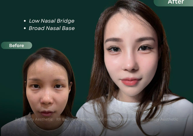 Rhinoplasty before and after results at R&R Beauty Aesthetic