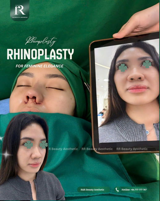 Rhinoplasty and alarplasty before and after results with R&R Beauty Aesthetic