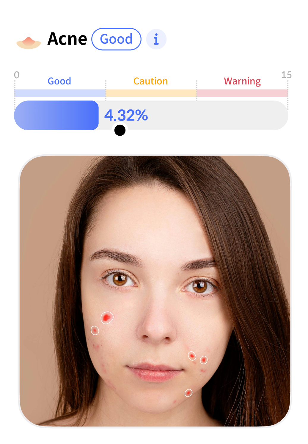 Acne Analysis
