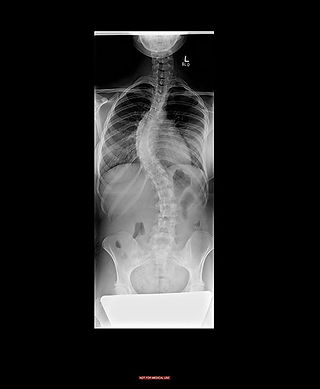 Nadia's Curved Spine