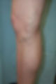 Foam Sclerotherapy