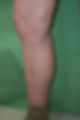 Foam Sclerotherapy