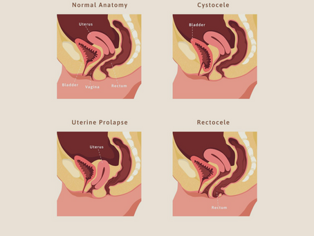 Pelvic Heaviness & Prolapse Physiotherapy | East Sussex Women's Health